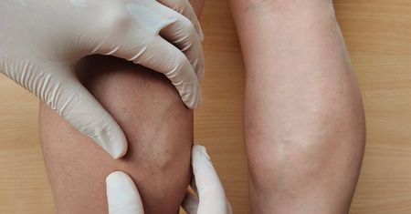 Zapalenie naczyń krwionośnych – przyczyny, objawy i rodzaje