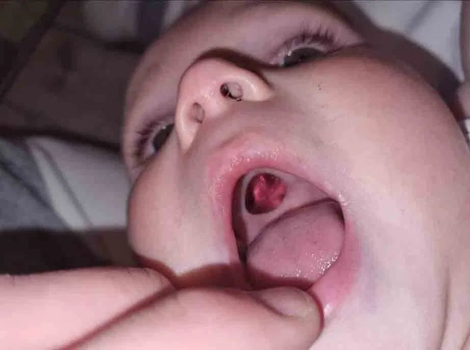 Podniebienie Harveya