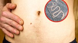 Nie lekceważ objawów. Sygnały, że od miesięcy możesz mieć tasiemca