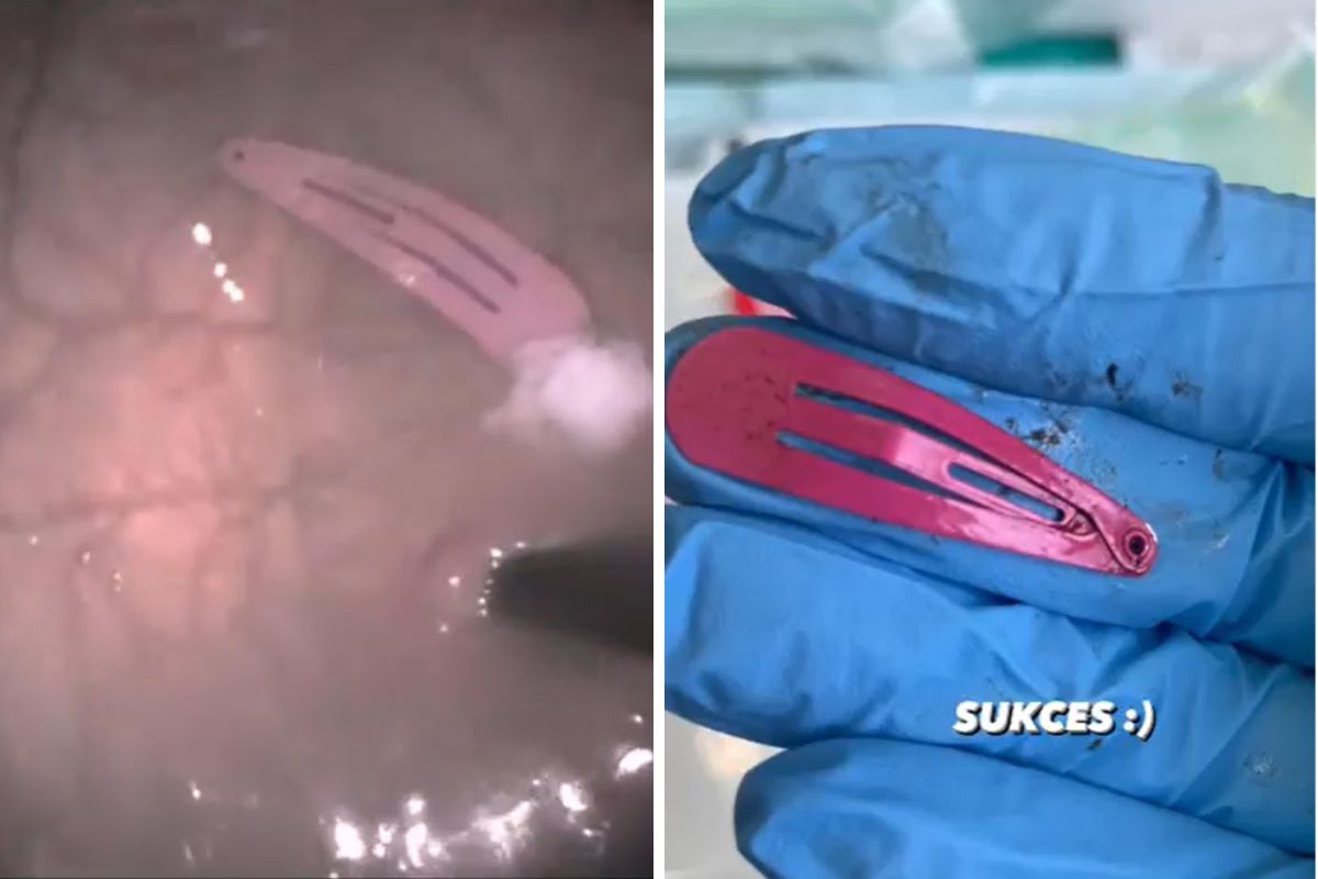 W żołądku znajdowała się różowa spinka