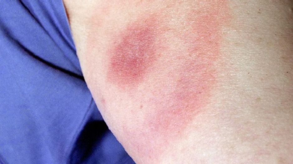 Objawy trzustki to nie tylko ból brzucha. Okazuje się, że chory narząd można zauważyć po zmianach na skórze