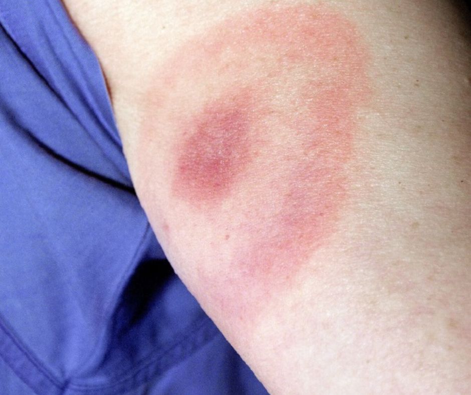 Charakterystyczne znamię. Pojawia się, gdy trzustka potrzebuje natychmiastowej pomocy