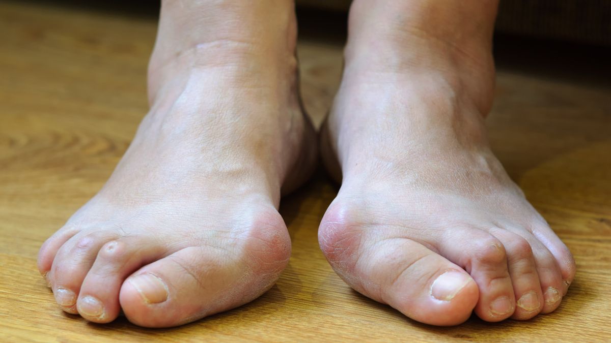 Haluksy to zarówno defekt kosmetyczny, jak i problem zdrowotny