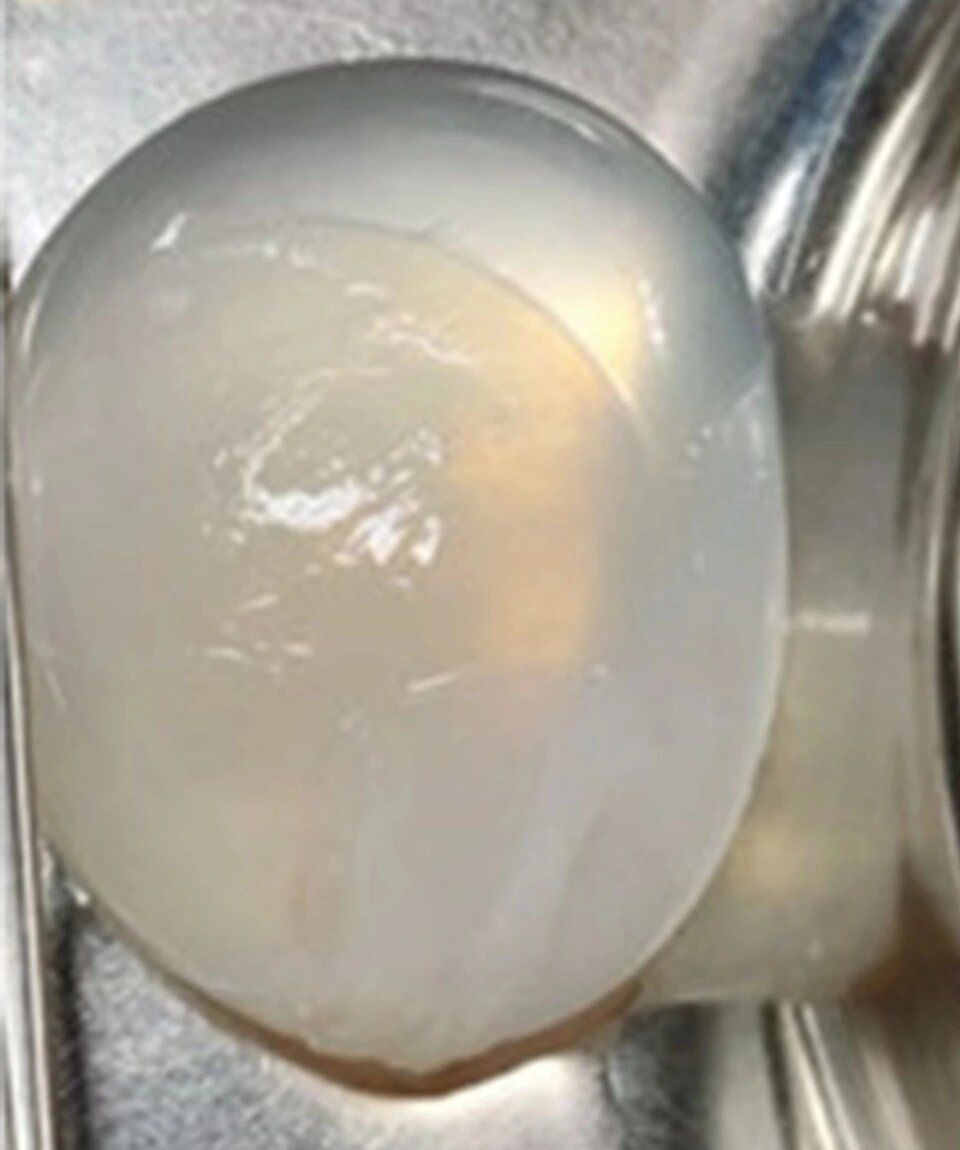 Lekarze wyjęli z mózgu 14-latka masywną torbiel