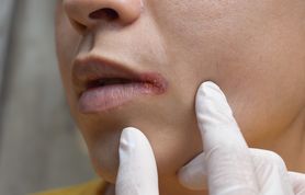 Grzybica jamy ustnej - objawy, przyczyny, leczenie, domowe sposoby