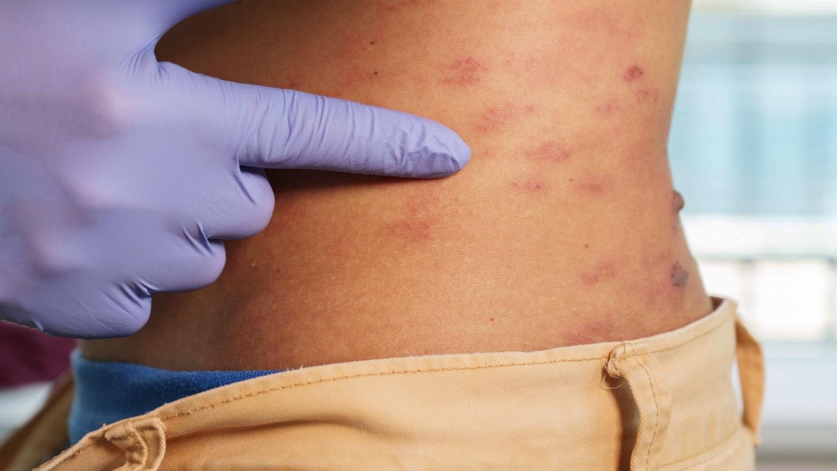 Osoby, ktore chorowały na półpasiec są bardzej narażone na udar i zawał