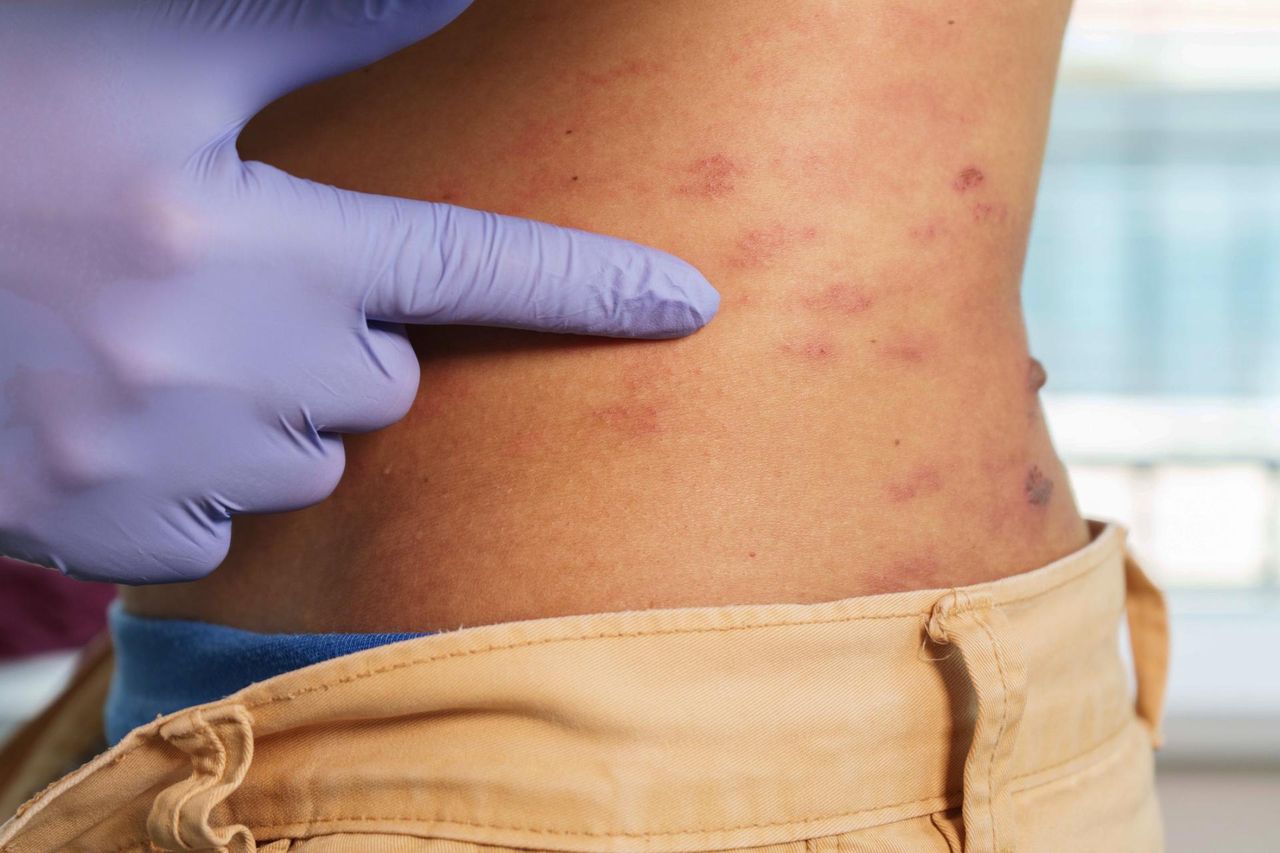 Zwiększa ryzyko udaru i zawału. Jest groźny nawet po wyzdrowieniu