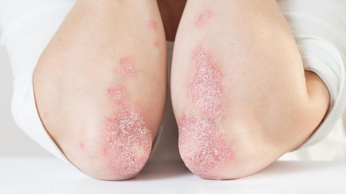 Choroby skóry to schorzenia o różnym podłożu, przebiegu i objawach, które manifestują się na ciele.