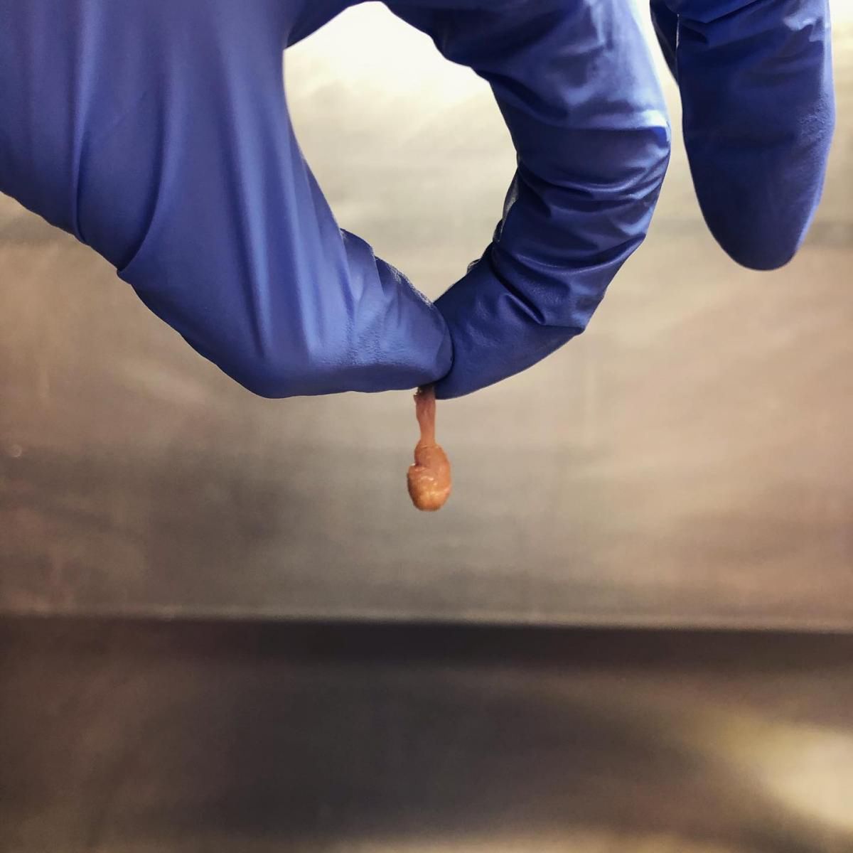 Polipy jelita grubego to drobne guzki diagnozowane w czasie kolonoskopii