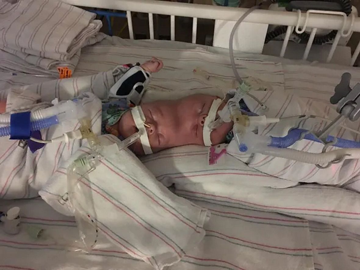 Urodziły się jako bliźniaczki syjamskie