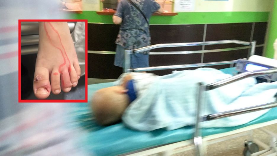 Na stopie pojawiła się czerwona kreska. Chłopiec ledwo uniknął amputacji