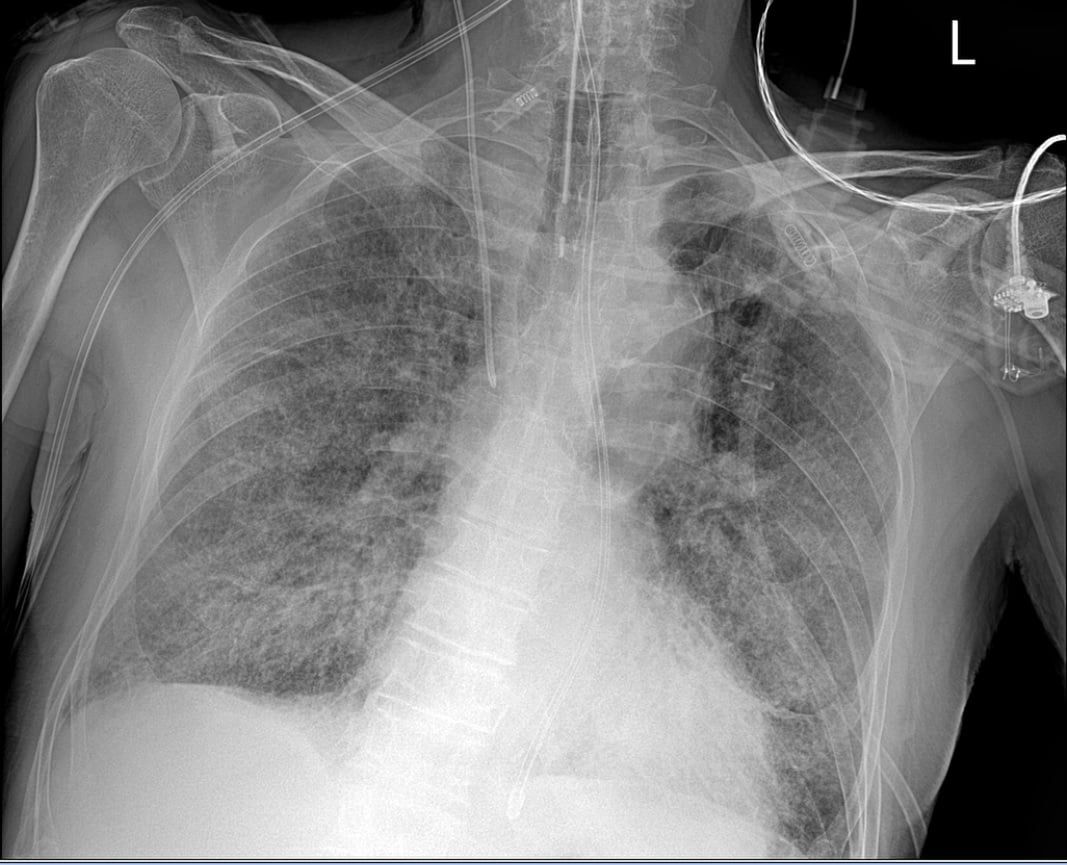 Obraz płuc, w którym 80 proc. powierzchni narządu jest zajęte przez wirusa