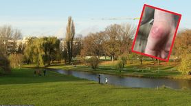 Dziecko poparzone po wizycie w parku w Warszawie. Jest wniosek o zamknięcie części obiektu