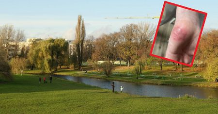 Dziecko poparzone po wizycie w parku w Warszawie. Jest wniosek o zamknięcie części obiektu