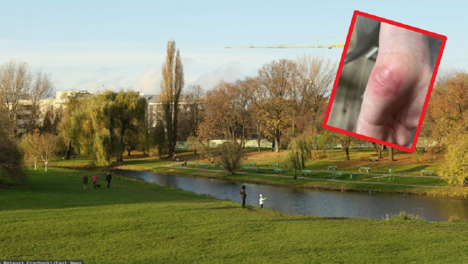 Chłopiec bawił się w warszawskim parku. Po powrocie do domu na jego ręku pojawiły się oparzenia