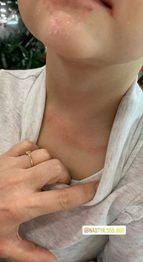 Anastasia za pośrednictwem mediów społecznościowych pokazała obrażenia dziewczynki po incydencie z liną