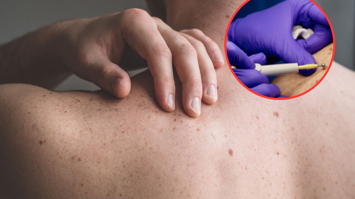 Diagnostyka czerniaka opiera się na dermatoskopii oraz badaniu histopatologicznym po wycięciu zmiany