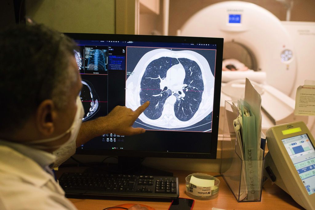 Powikłania po COVID mogą się ujawniać przez wiele miesięcy po przejściu samej infekcji