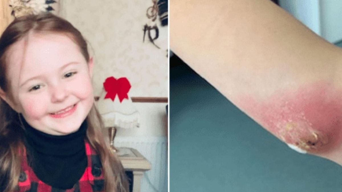 Rana po ukąszeniu była tak duża, że należało ją zoperować