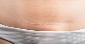 Dzieci urodzone przez cesarskie cięcie mają większe ryzyko otyłości
