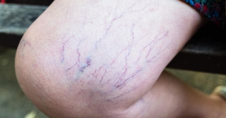 Pajączki na nogach to nie tylko problem estetyczny. Mogą ostrzegać o groźnym schorzeniu