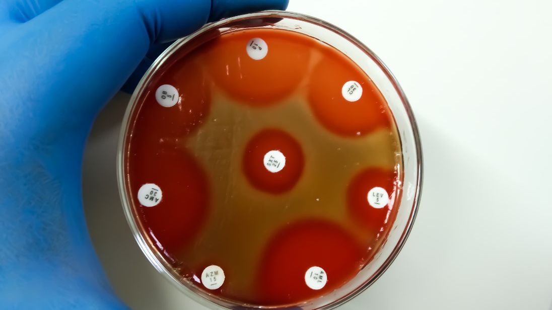 Paciorkowcowy zespół wstrząsu toksycznego