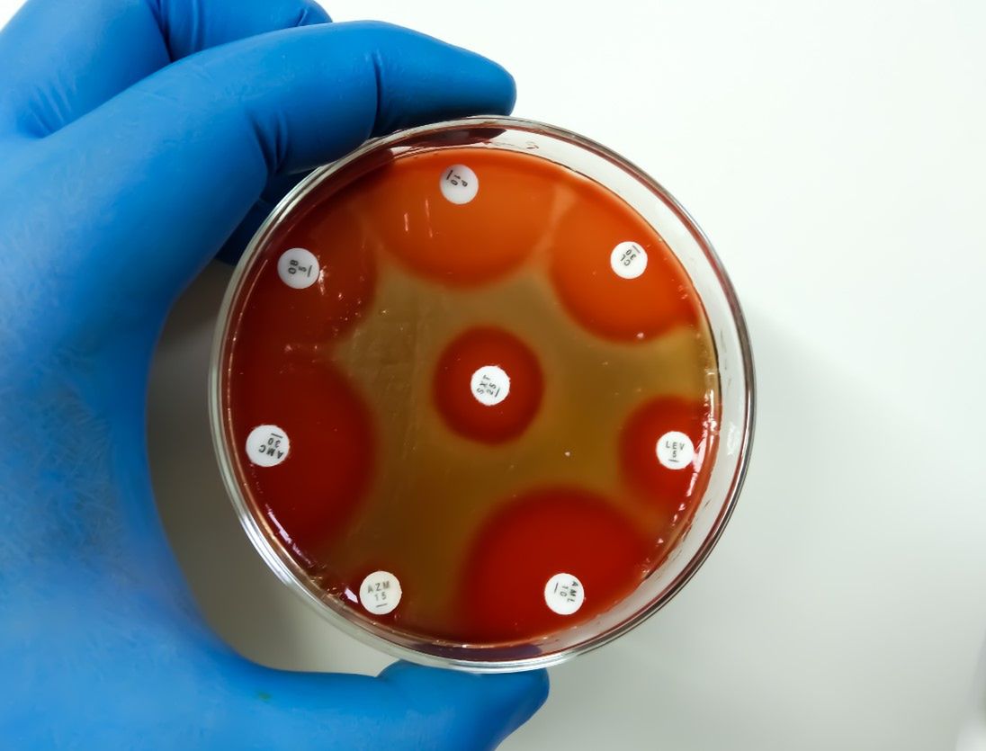 Paciorkowcowy zespół wstrząsu toksycznego – przyczyny, objawy i leczenie