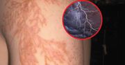 Oczy robią się czarne, a na ciele pojawia się "rozgałęzione drzewo". Przeżywa 50 proc. osób
