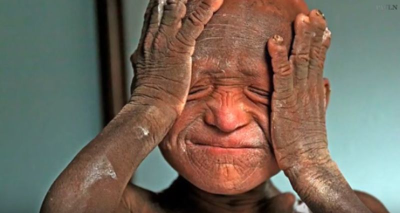 Chopiec cierpiący na rzadką chorobę skórną / youtube.com