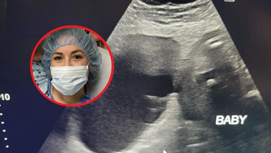 Torbiel jajnika była dwa razy większa niż płód