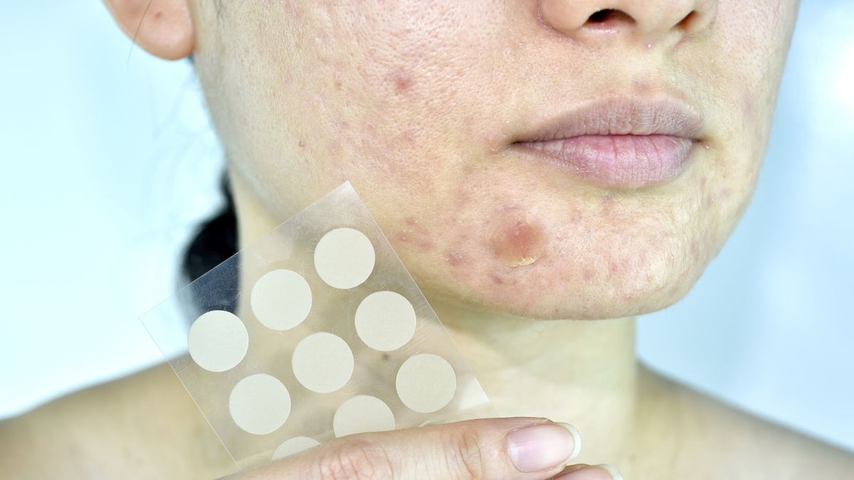 Plastry na pryszcze przyspieszają gojenie się krosty i skóry