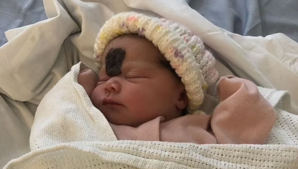 Lekarze odmówili operacji wycięcia znamienia