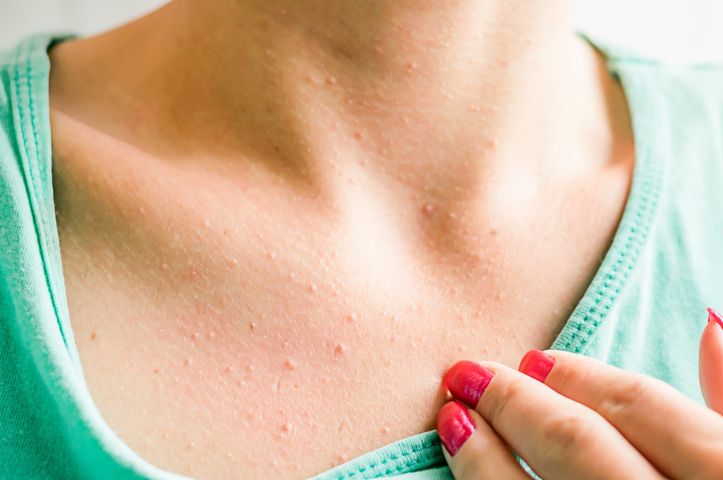 Krostki na dekolcie mogą być spowodowane różnymi czynnikami np. alergią pokarmową.
