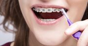 Aparat ortodontyczny - rodzaje, wskazania, przeciwwskazania i cena