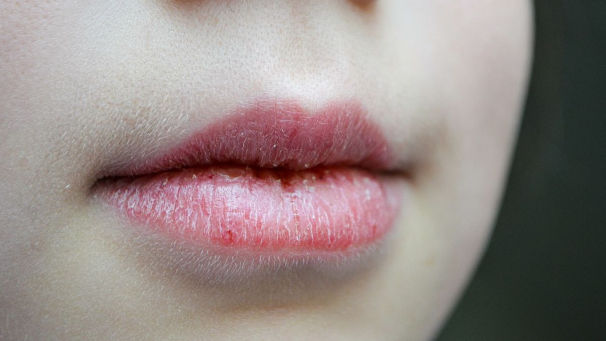 Zapalenie czerwieni wargowej to choroba ust, istotą której jest stan zapalny warg.