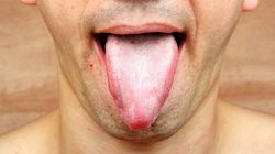 Plamki na języku - jak wyglądają i skąd się biorą?