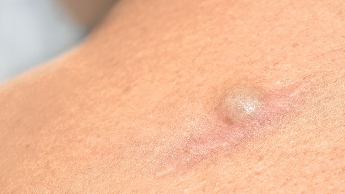 Kaszak złośliwy nie jest - to pewne. Jest nowotworem o łagodnym charakterze, tak samo jak mylony z nim prosak.