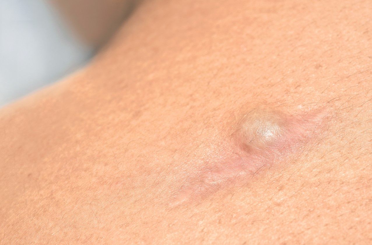 Kaszak złośliwy? Co to za zmiana?