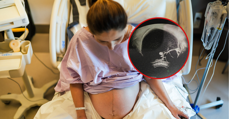 Potworniak miał 20 cm i ważył 770 g. Historia Wiktorii pokazuje, jak ważne są badania prenatalne