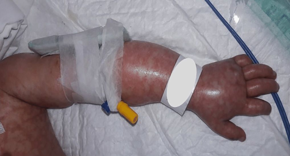 Zmiany na skórze u pacjenta z COVID-19