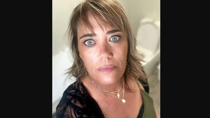 Pryszcza przykrywała korektorem. Rok później okazało się, że to rak skóry