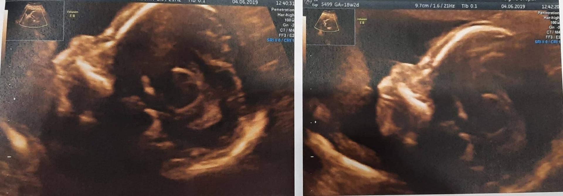 Każde kolejne badania wykazywało brak kości nosowej u dziecka