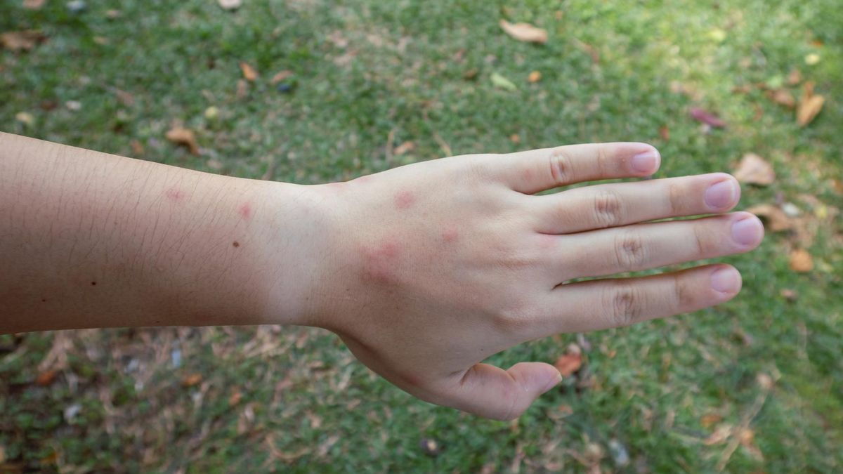 Objawy chorej wątroby mogą pojawić się na skórze