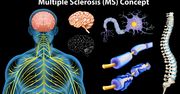 Stwardnienie rozsiane (SM) - objawy, przyczyny, leczenie