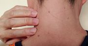 Pojawiły się na twarzy lub szyi? Mogą świadczyć o zakażeniu lub raku