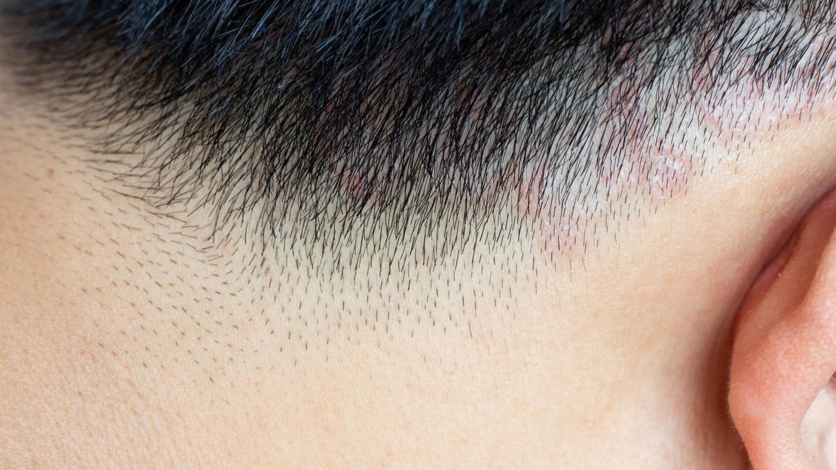 Łupież pstry to infekcja grzybicza skóry.