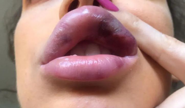 Usta wypełnione kwasem hialuronowym