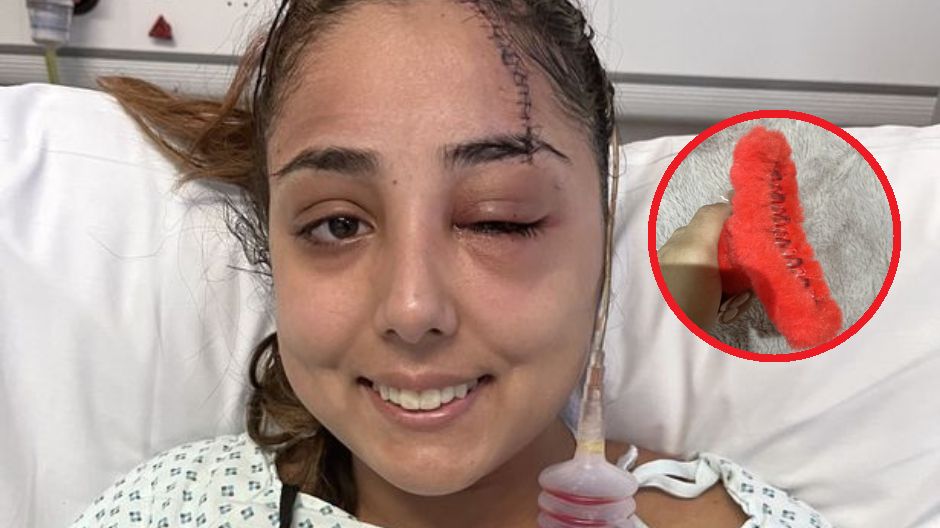 Klamerka do włosów rozcięła jej głowę podczas wypadku