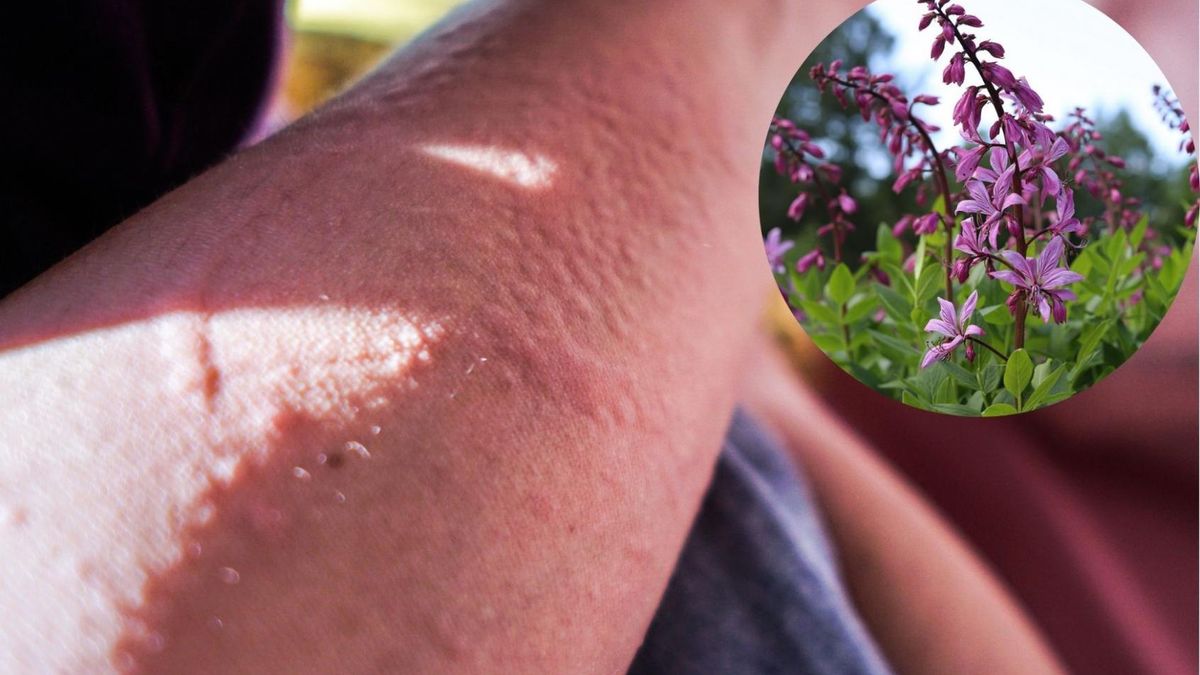 Uwaga na leki i kosmetyki na bazie fototoksycznych roślin. Mogą doprowadzić do silnej reakcji alergicznej, jeżeli wystawisz skórę na słońce