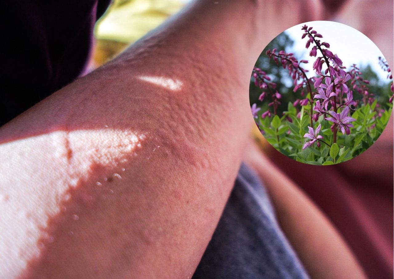 Fotouczulające rośliny. "Efekt jak po oparzeniu wrzątkiem"